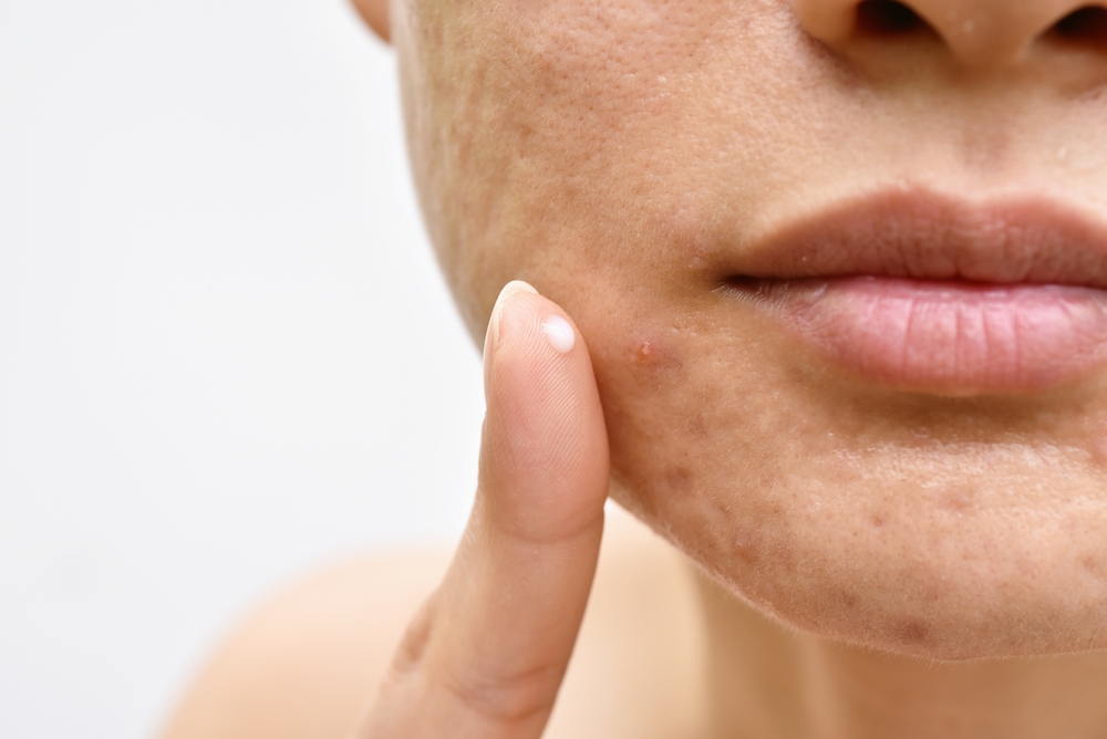 woman-face-with-acne-scars-and-hyperpigmentation