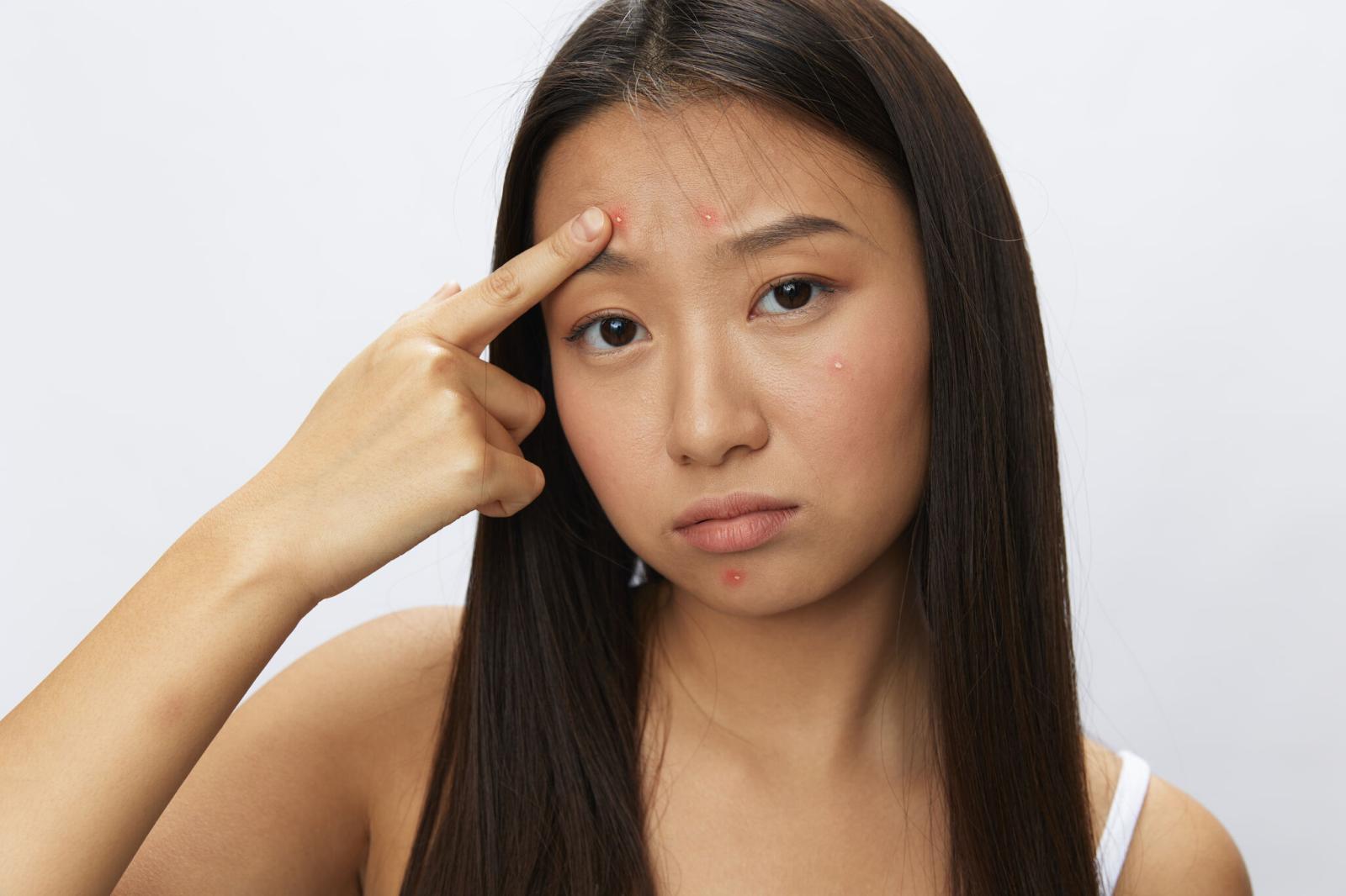woman-upset-about-her-pimple-inflammation