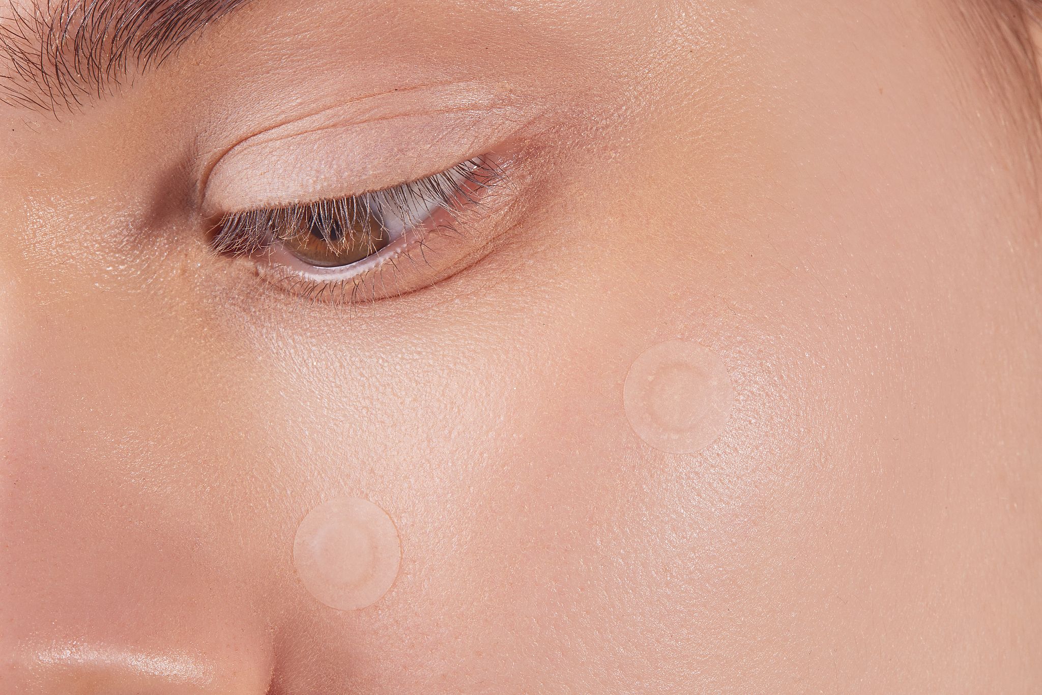 girl-with-round-acne-patches-on-her-cheek