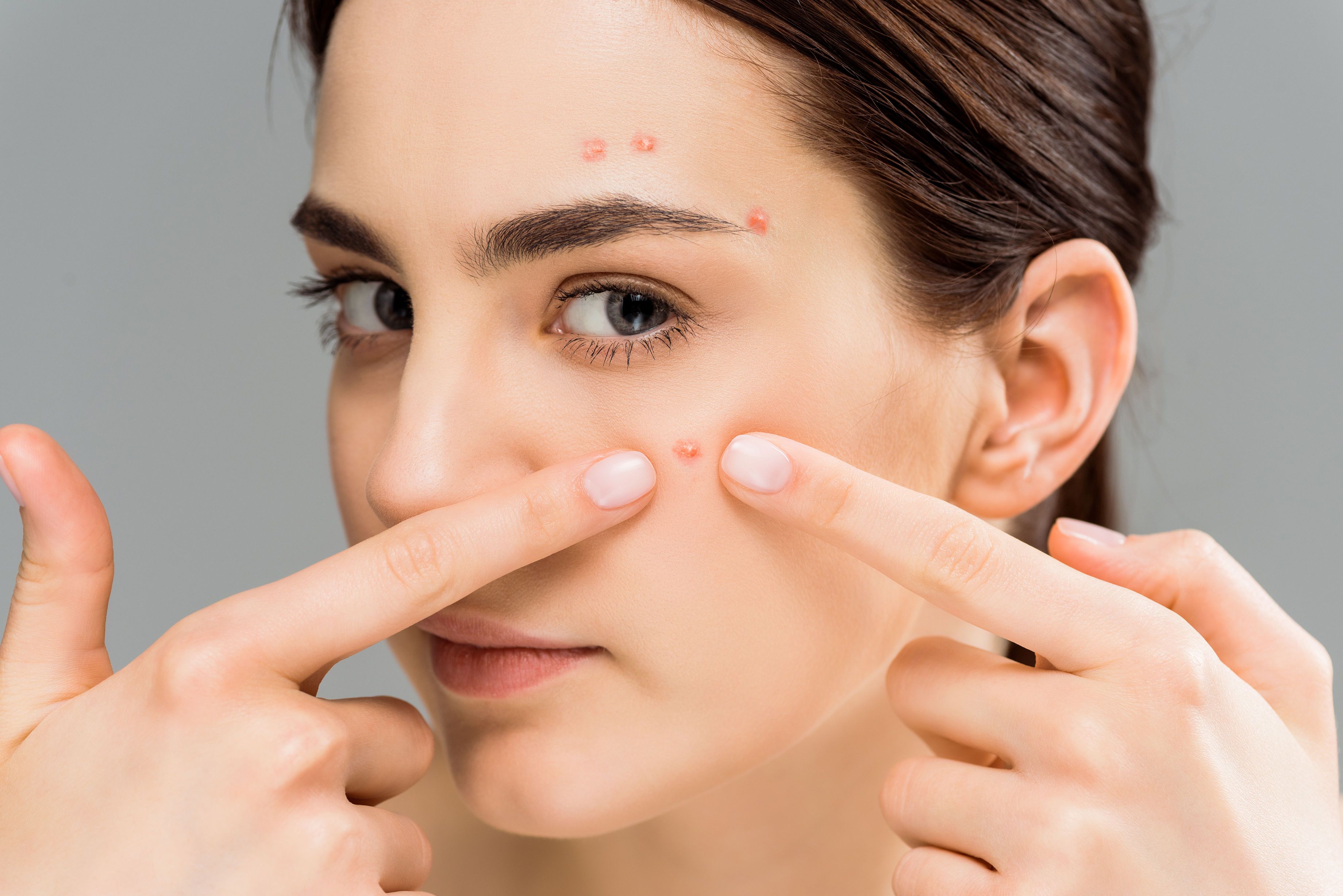 woman-with-red-pimples-touching-her-face