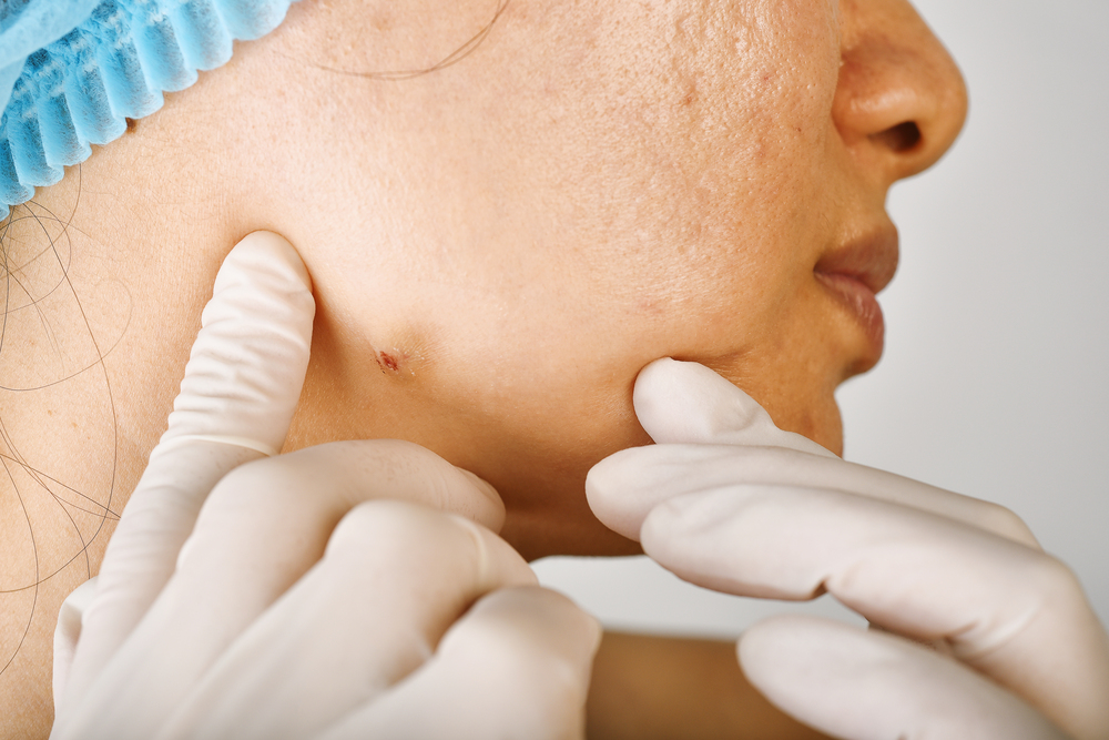 woman-face-with-acne-scars